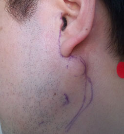 画像ギャラリー No.011のサムネイル画像 / 【西川善司】腫瘍摘出手術を受けて自らがバイオハザード風になった話